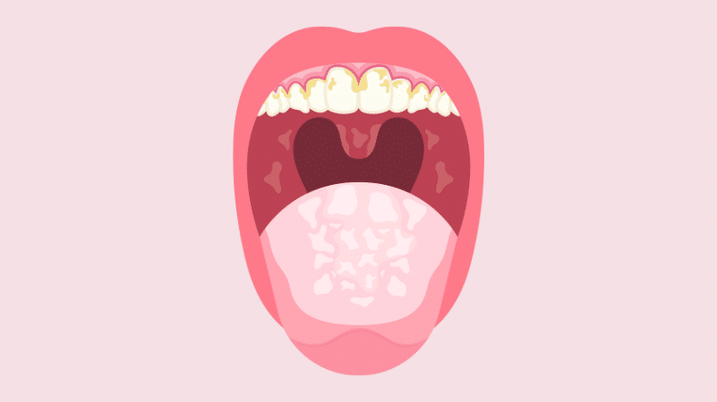 importance of oral cancer screenings