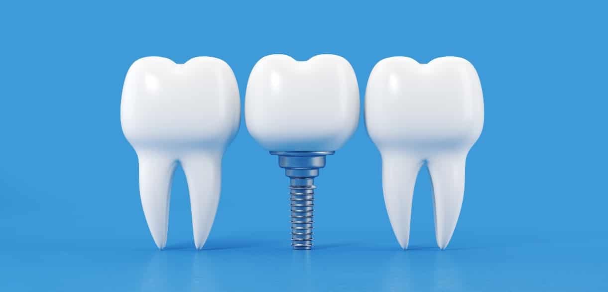 how does smoking affect dental implants