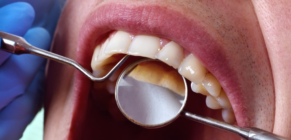 how dental exams reveal what is really behind your sensitive teeth