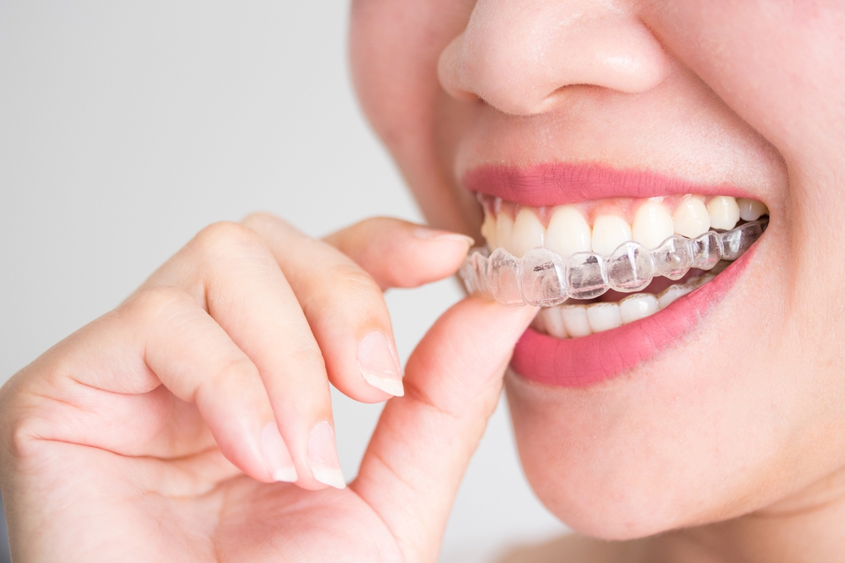 Invisalign-in-Miami-Gardens