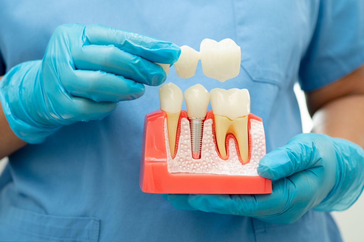 When Can I Eat After Dental Implants